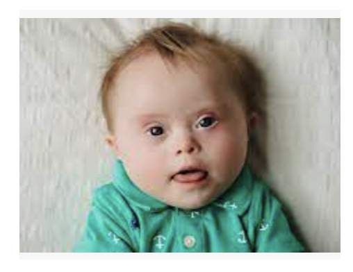 Child with down syndrome